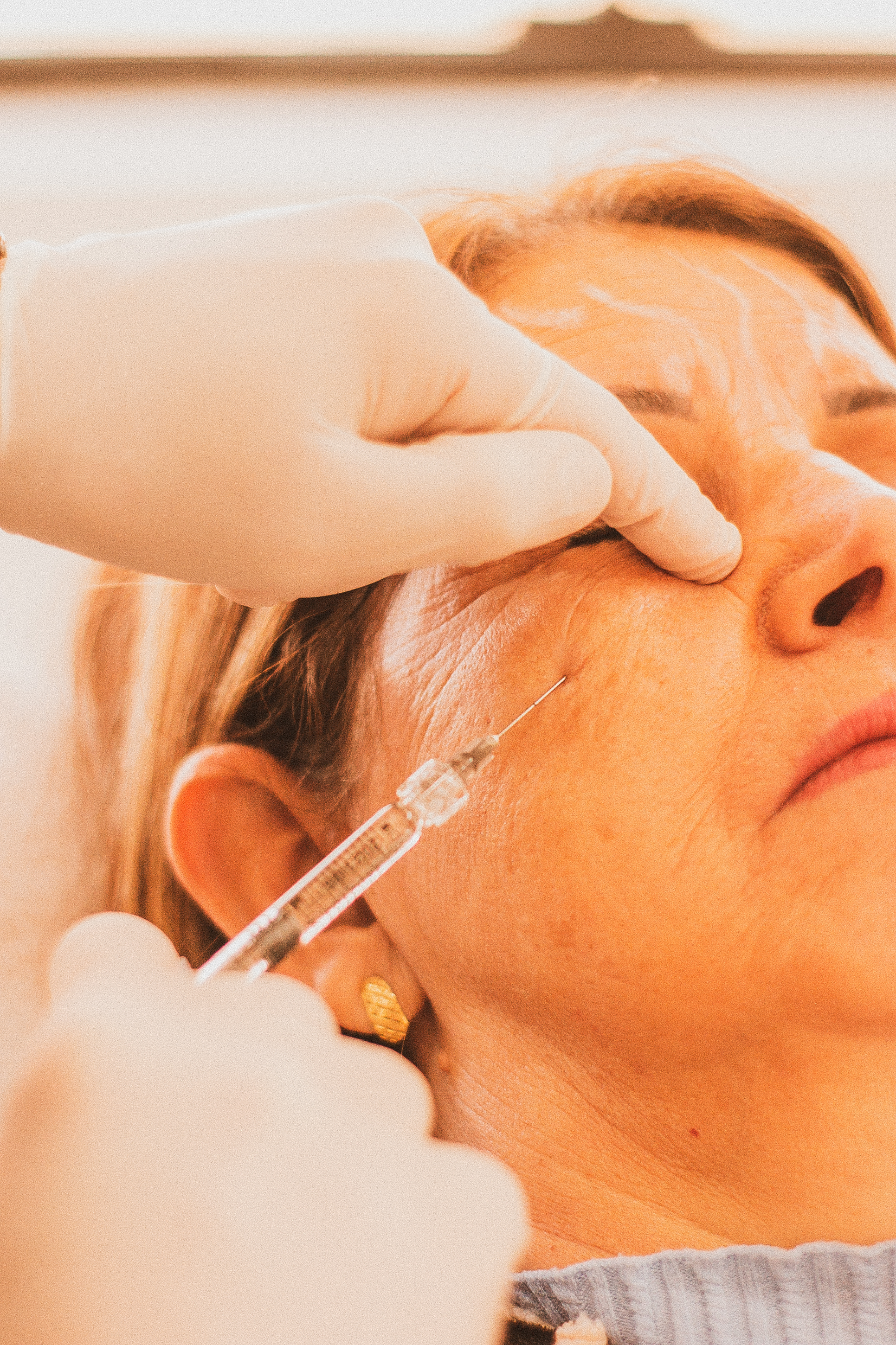 Botox ou preenchimento: qual o melhor?