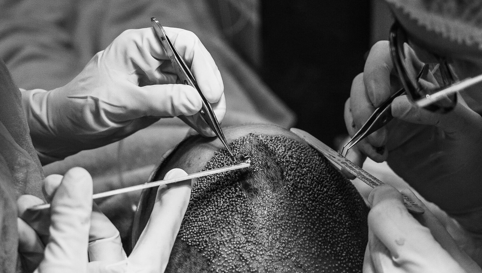 Transplante capilar: tudo sobre o pós-operatório